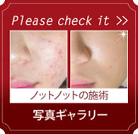 グリーンピールビフォアーアフター ノットノットの施術 写真ギャラリー