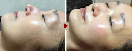 グリーンピール＋ACトリートメント