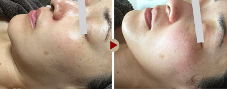 ACトリートメント