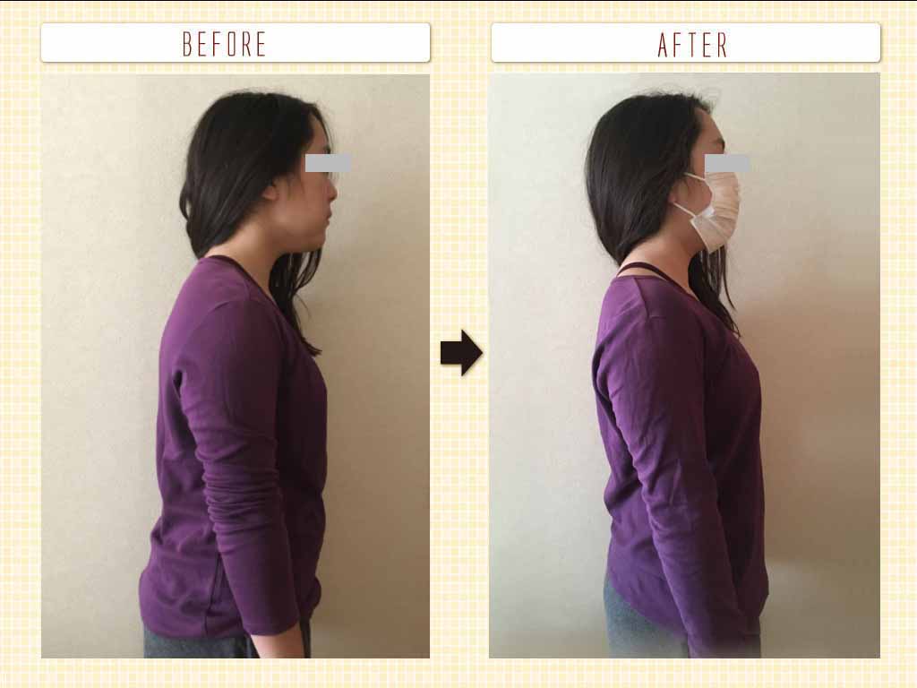 ビフォーアフター<施術１回>