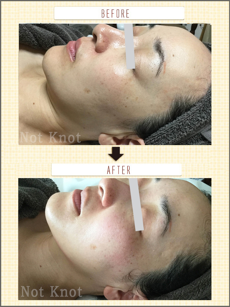 リアボーテACトリートメント ビフォーアフター<施術２回>