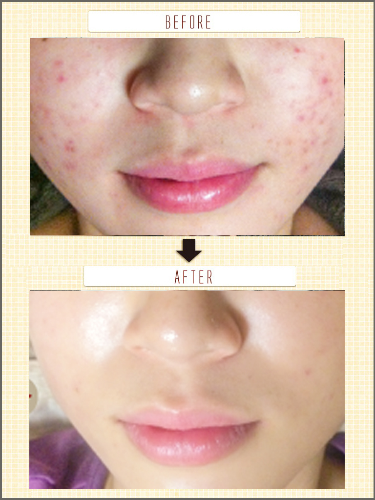 ビフォーアフター<施術３回>